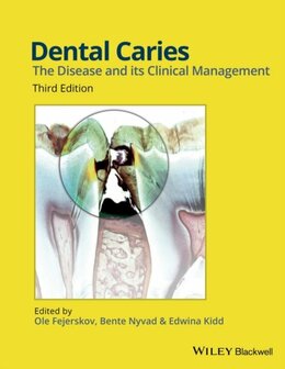 Dental Caries | 9781118935828 